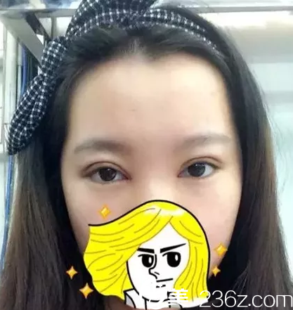 在玉林华美做双眼皮手术后7天 在玉林华美做双眼皮手术后7天