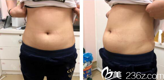 腰腹部吸脂术前照片 腰腹部吸脂术前照片