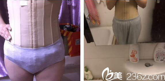 在深圳非凡医院做完吸脂两天了 在深圳非凡医院做完吸脂两天了