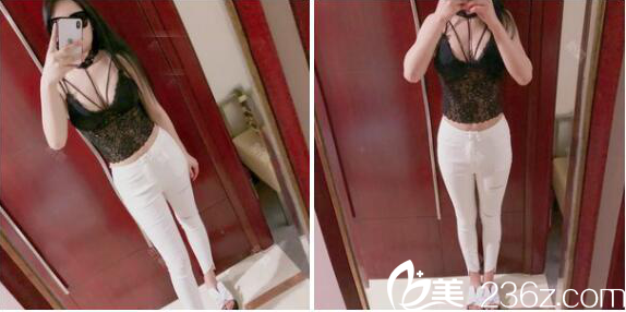 深圳非凡医院腰腹部吸脂一个月效果展示 深圳非凡医院腰腹部吸脂一个月效果展示