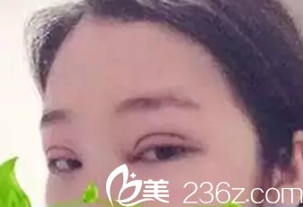 桂美人做双眼皮和开眼角即刻<span style= 桂美人做双眼皮和开眼角即刻<span style=