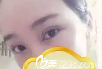 做完双眼皮和开眼角3天恢复照 做完双眼皮和开眼角3天恢复照