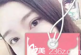 桂美人整形割双眼皮开眼角<span style= 桂美人整形割双眼皮开眼角<span style=