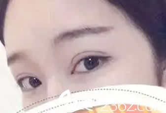 做完双眼皮12天恢复<span style= 做完双眼皮12天恢复<span style=