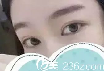 看到衢州桂美人袁细牙有多年眼鼻手术经验,就放心地找他做了双眼皮和开眼角
