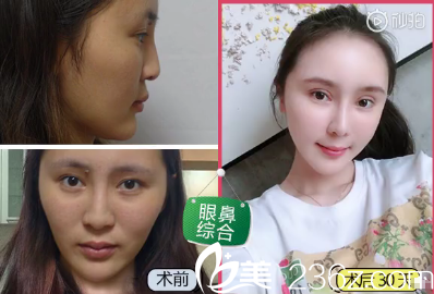 陈星双眼皮隆鼻手术后效果 陈星双眼皮隆鼻手术后效果