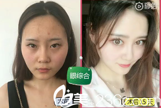 陈星双眼皮做的好吗?看案例 陈星双眼皮做的好吗?看案例