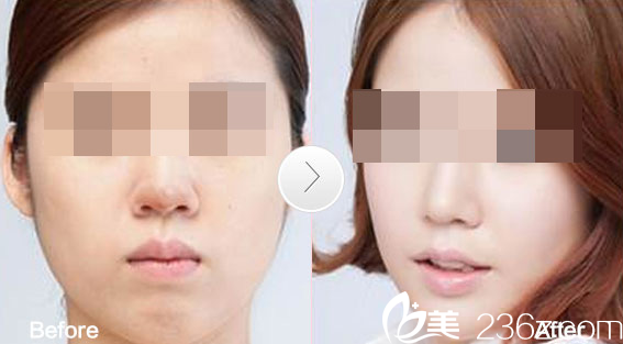 我在广州海峡整形医院做鼻部清奥和修复效果图