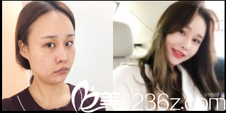 韩国dreamline吸脂塑形医院螺纹提升+填充物+瘦脸