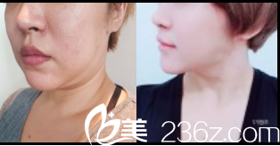 韩国dreamline吸脂塑形医院面部吸脂+纱线提升 韩国dreamline吸脂塑形医院面部吸脂+纱线提升