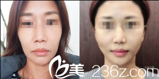 韩国dreamline吸脂塑形医院双线提升 韩国dreamline吸脂塑形医院双线提升