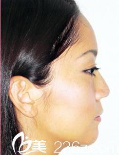 我的日本混血整形体验---自由之丘佐藤英明医生做的隆鼻术前后效果对比