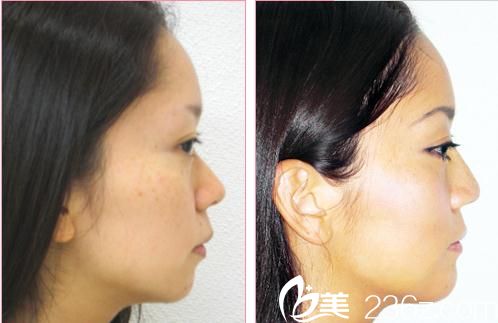 隆鼻术前后对比