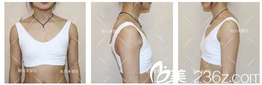 面诊吕韩伟医生术前干瘪的胸部 面诊吕韩伟医生术前干瘪的胸部