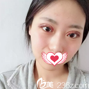 在沈阳美莱割双眼皮术后天 在沈阳美莱割双眼皮术后天