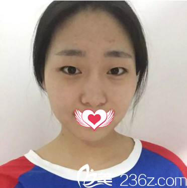 割双眼皮术前照 割双眼皮术前照