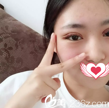 割双眼皮术后第5天<span style= 割双眼皮术后第5天<span style=