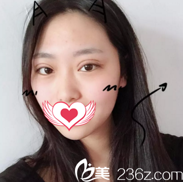 做双眼皮整形术后一周拆线 做双眼皮整形术后一周拆线