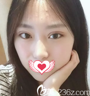 割双眼皮术后半个月<span style= 割双眼皮术后半个月<span style=