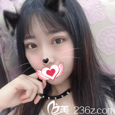 沈阳美莱做双眼皮怎么样？医生给我做的切开双眼皮术后2个月恢复效果图