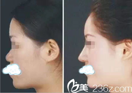 自体脂肪隆鼻 自体脂肪隆鼻