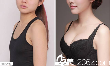 自体脂肪丰胸前后对比 自体脂肪丰胸前后对比