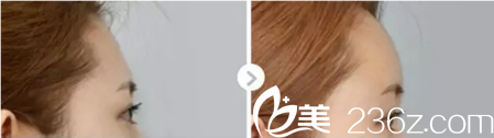自体脂肪填充额头案例 自体脂肪填充额头案例