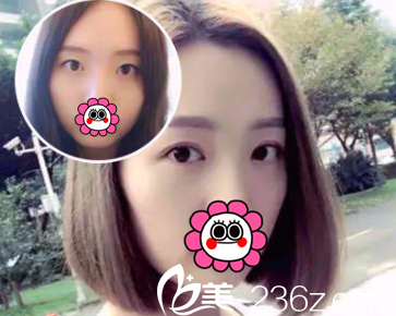 北京南加割双眼皮多少钱？医院眼整形价格表和案例抢先看