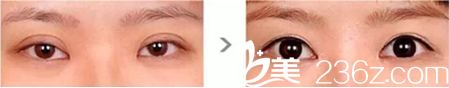 沈割双眼皮怎么样？眼部修复案例
