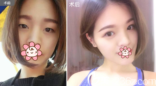 双眼皮开眼角术后效果