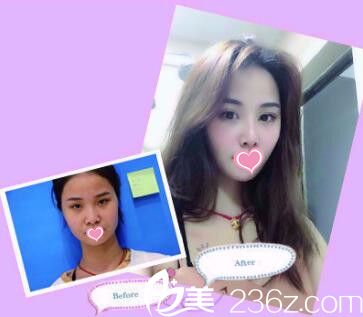 海南兰颜慧医学美容医院鼻综合真人前后对比 海南兰颜慧医学美容医院鼻综合真人前后对比