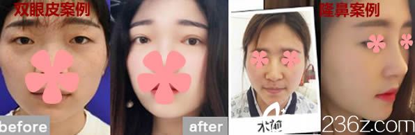 福州玛恩徐杰医生双眼皮及鼻综合隆鼻案例 福州玛恩徐杰医生双眼皮及鼻综合隆鼻案例