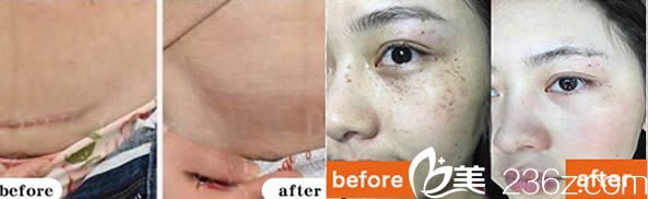 福州玛恩刘剑剖腹产祛疤痕案例及激光祛斑前后对比效果 福州玛恩刘剑剖腹产祛疤痕案例及激光祛斑前后对比效果