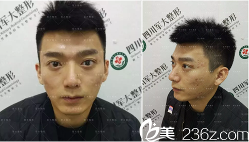 面部脂肪填充术前照片 面部脂肪填充术前照片