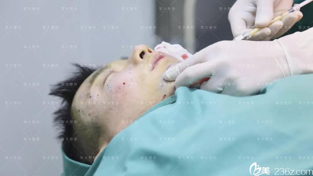 自体脂肪填充面部手术中 自体脂肪填充面部手术中