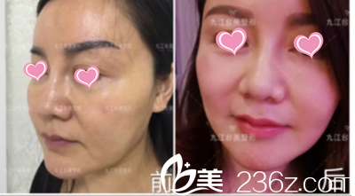 即刻效果对比图