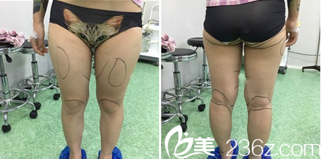大小腿吸脂术前设计