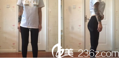 大腿吸脂4天后正面侧面照片