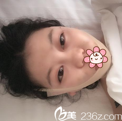 面部吸脂术后即刻