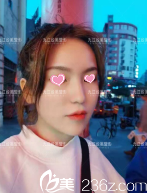 九江台美美容整形医院注射瘦脸效果