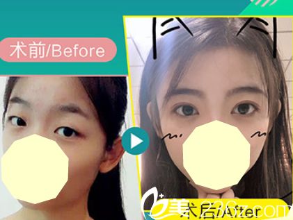 真人案例及反馈见证合肥美舒雅整形怎么样 再看美舒雅整形价格表心动变行动