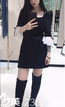 <i data-id='82eb1d34-6b77-4d6f-a381-8bd7586dfd21' style='display:none;'></i>大腿小腿吸脂术后2个月照片