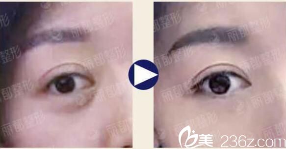 在无锡丽都做微创去眼袋术前术后对比案例 在无锡丽都做微创去眼袋术前术后对比案例