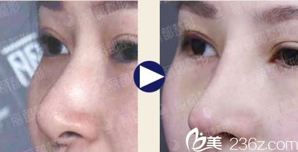 到无锡丽都做合资假体隆鼻案例对比 到无锡丽都做合资假体隆鼻案例对比