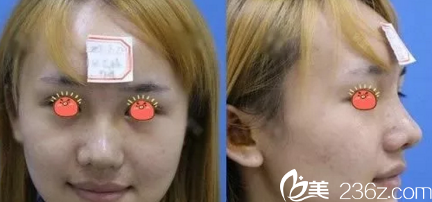 我在桂林华美做鼻综合手术后7天