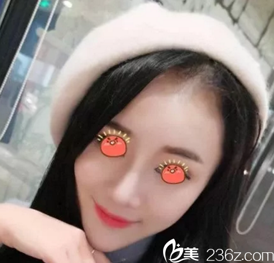 我在桂林华美做鼻综合手术后1个月