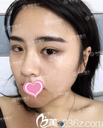 瑞韩萝莉大眼术后第3天