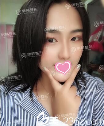 在瑞韩做双眼皮术后20天效果