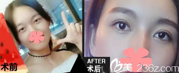 厦门脸博士贾洪仁双眼皮7mm一年后照片