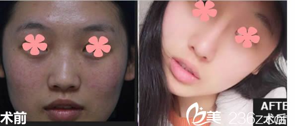 贾洪仁院长鼻综合隆鼻前后对比效果